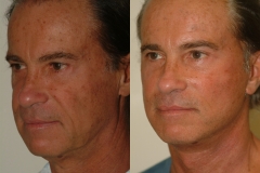 male-facelift_3b