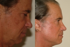 male-facelift_3d