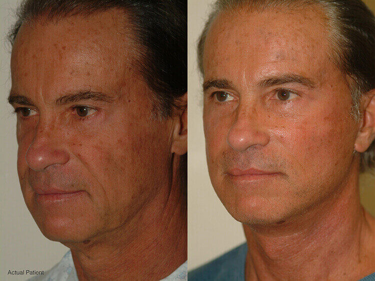 Lower Blepharoplasty Additional Actual Patient Results