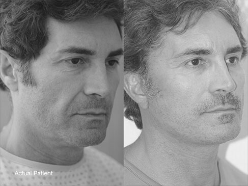 The Male Facelift Additional Actual Patient Results