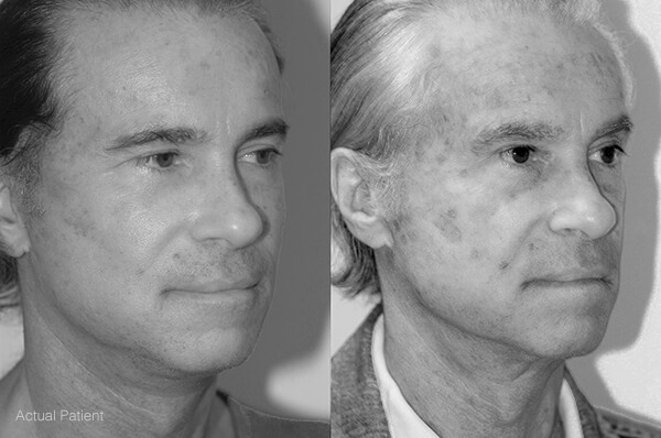 Neck Lift Actual Patient Results