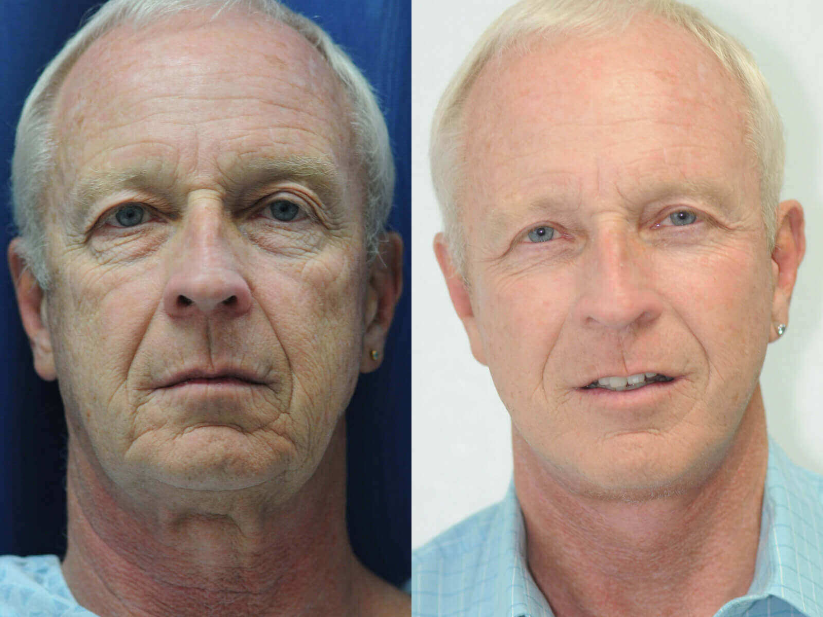 Upper Blepharoplasty Actual Patient Results