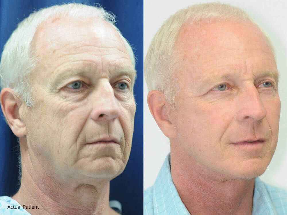 Patient after a vertical facelift