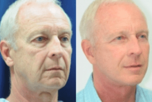 Calabraia Male Facelift Patient