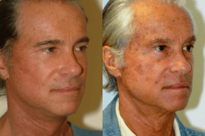 Revision Facelift Dr Calabria