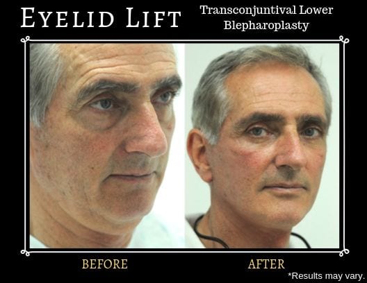 Before and after image showing the results of a transconjunctival lower blepharoplasty surgery on a male patient.