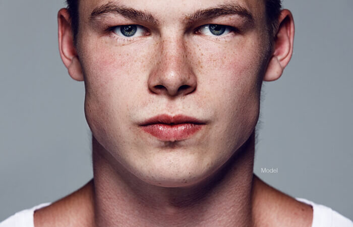 young male model facing forward for facial implants
