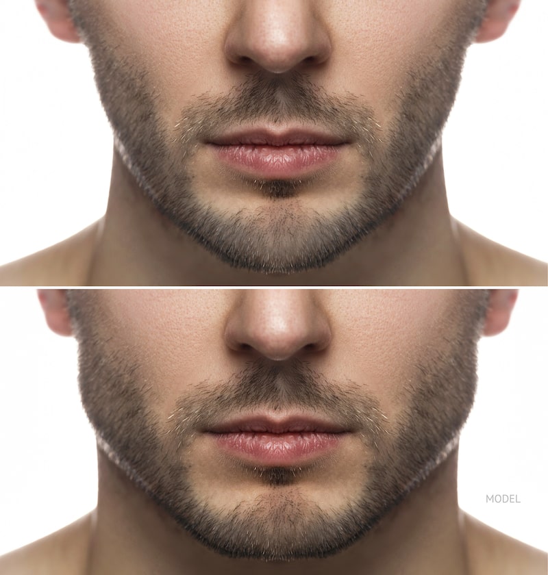 Man before and after his jawline contouring surgery with jaw implant.