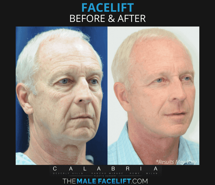 Before and after image showing the results of a male facelift performed in Beverly Hills