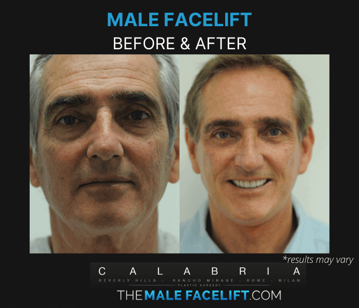 Before and after image showing the results of a male facelift performed in Beverly Hills, CA.