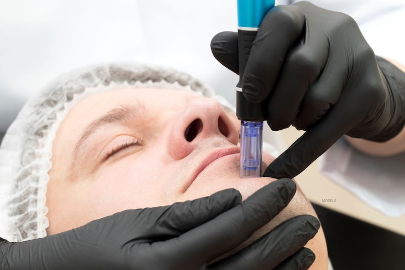 A man receives a microneedling treatment.